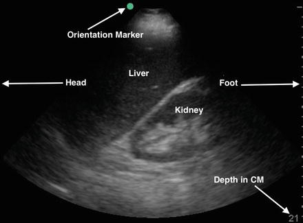 Abdominal Ultrasound